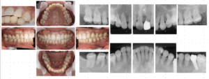SPT移行時の口腔内写真・エックス線写真・歯周組織検査　（202３年 ７月） 