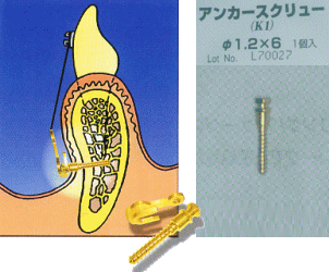 ミニインプラント